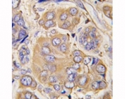 IHC analysis of FFPE human breast carcinoma tissue stained with HSPB1 antibody