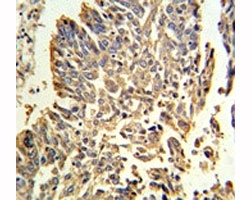 HSP27 antibody IHC analysis in formalin fixed and paraffin embedded human lung carcinoma.~
