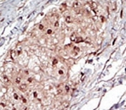 IHC analysis of FFPE human hepatocarcinoma tissue stained with the SPHK1 antibody