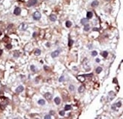 IHC analysis of FFPE human hepatocarcinoma tissue stained with the SPHK2 antibody.