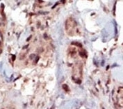 IHC analysis of FFPE human breast carcinoma tissue stained with the SPHK2 antibody.