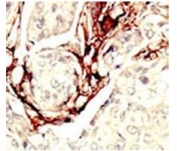 IHC analysis of FFPE human breast carcinoma tissue stained with the LKB1 antibody