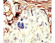 IHC analysis of FFPE human breast carcinoma tissue stained with the STK11 antibody