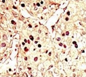 IHC analysis of FFPE human hepatocarcinoma tissue stained with the Aurora B antibody