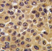 IHC analysis of FFPE human breast carcinoma tissue stained with CDC25B antibody