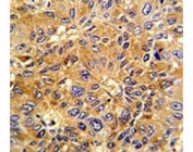 IHC analysis of FFPE human hepatocarcinoma with Cyclin A2 antibody