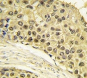 IHC analysis of FFPE human breast carcinoma tissue stained with Cyclin A2 antibody