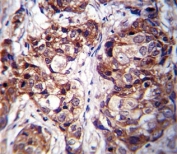 DDR1 antibody immunohistochemistry analysis in formalin fixed and paraffin embedded human breast carcinoma.