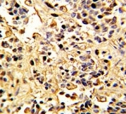 IHC analysis of FFPE human kidney carcinoma with Neprilysin antibody