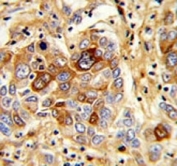 IHC analysis of FFPE human hepatocarcinoma with CD163 antibody