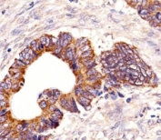 Immunohistochemical analysis of paraffin-embedded human colorectal carcinoma section using PCSK9 antibody