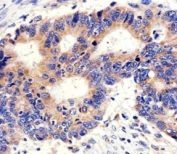 IHC analysis of FFPE human colon carcinoma section using anti-PCSK9 antibody; Ab was diluted at 1:100.