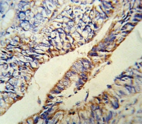 Anti-PCSK9 antibody IHC analysis in formalin fixed and paraffin embedded human colon carcinoma.