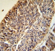 PITX1 antibody IHC analysis in formalin fixed and paraffin embedded human lung carcinoma.