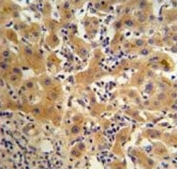 Ceruloplasmin antibody IHC analysis in formalin fixed and paraffin embedded human hepatocarcinoma
