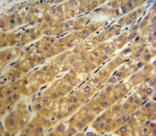 CP antibody IHC analysis in formalin fixed and paraffin embedded human hepatocarcinoma.