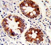 IHC analysis of FFPE human colon carcinoma with Cytokeratin-18 antibody