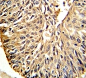 DHFR antibody IHC analysis in formalin fixed and paraffin embedded human lung carcinoma.