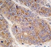 IHC analysis of FFPE human hepatocarcinoma tissue stained with Apolipoprotein A-II antibody