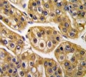 IHC analysis of FFPE human hepatocarcinoma tissue stained with IDH1 antibody