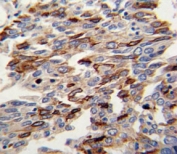 IHC analysis of FFPE human lung carcinoma with CD31 antibody