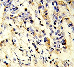 IHC analysis of FFPE human breast carcinoma stained with IGHM antibody