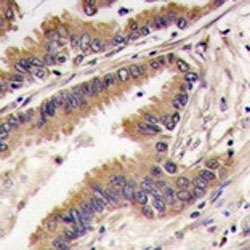IHC analysis of FFPE human lung carcinoma tissue stained with ERK4 antibody~