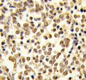 IHC analysis of FFPE human kideny carcinoma tissue stained with ERK5 antibody