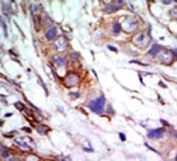 IHC analysis of FFPE human breast carcinoma tissue stained with the ERK5 antibody