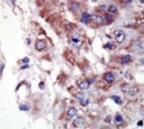 IHC analysis of FFPE human hepatocarcinoma tissue stained with the JNK2 antibody