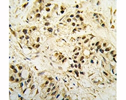 IHC analysis of FFPE human breast carcinoma tissue stained with CDC2 antibody~