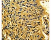 IHC analysis of FFPE human lung carcinoma stained with CDK2 antibody