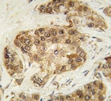 IHC analysis of FFPE human breast carcinoma tissue stained with CDK2 antibody