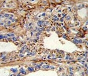 IHC analysis of FFPE human prostate carcinoma with CDK4 antibody