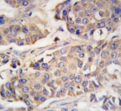 IHC analysis of FFPE human breast carcinoma tissue stained with ACO2 antibody