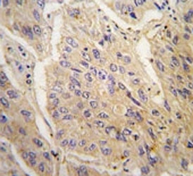 IHC analysis of FFPE human lung carcinoma tissue stained with anti-Caspase-3 antibody