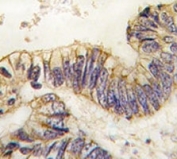 IHC analysis of FFPE human colon carcinoma tissue stained with SRC-1 antibody