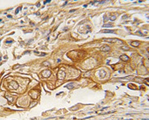 IHC analysis of FFPE human lung carcinoma tissue stained with ACPP antibody~