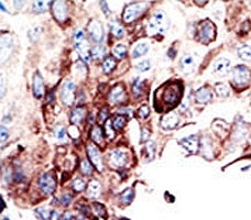 IHC analysis of FFPE human cancer tissue stained with the AXL antibody~