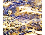 IHC analysis of FFPE human colon carcinoma stained with AXL antibody