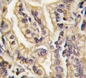 IHC analysis of FFPE human lung carcinoma tissue stained with CSF1R antibody