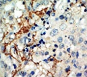 IHC analysis of FFPE human breast carcinoma tissue stained with the EphA3 antibody