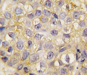 IHC analysis of FFPE human breast carcinoma tissue stained with EphB2 antibody