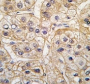 IHC analysis of FFPE human hepatocarcinoma tissue stained with the EGF Receptor antibody