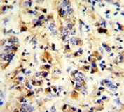 IHC analysis of FFPE human breast carcinoma stained with Epidermal growth factor receptor antibody