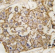 IHC analysis of FFPE human breast carcinoma tissue stained with ErbB2 antibody