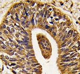 IHC analysis of FFPE human prostate carcinoma tissue stained with anti-HER2 antibody