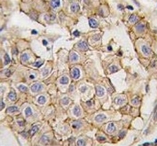 IHC analysis of FFPE human breast carcinoma tissue stained with HER2 antibody
