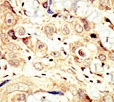 IHC analysis of FFPE human breast carcinoma tissue stained with the HER4 antibody