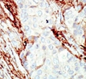 IHC analysis of FFPE human breast carcinoma tissue stained with the FGFR1 antibody